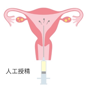 intrauterine-artificial-insemination